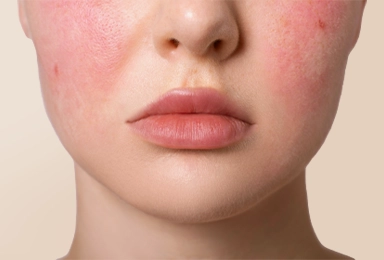 Rosacea